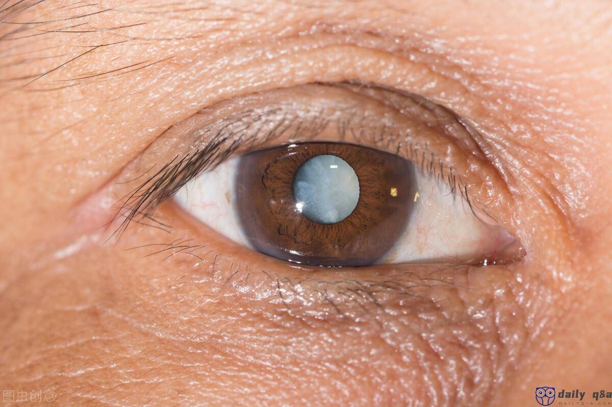 Cataract is a common disease of the elderly, do I need to wait for the blindness of the eyes to be treated?  Don't get the timing wrong