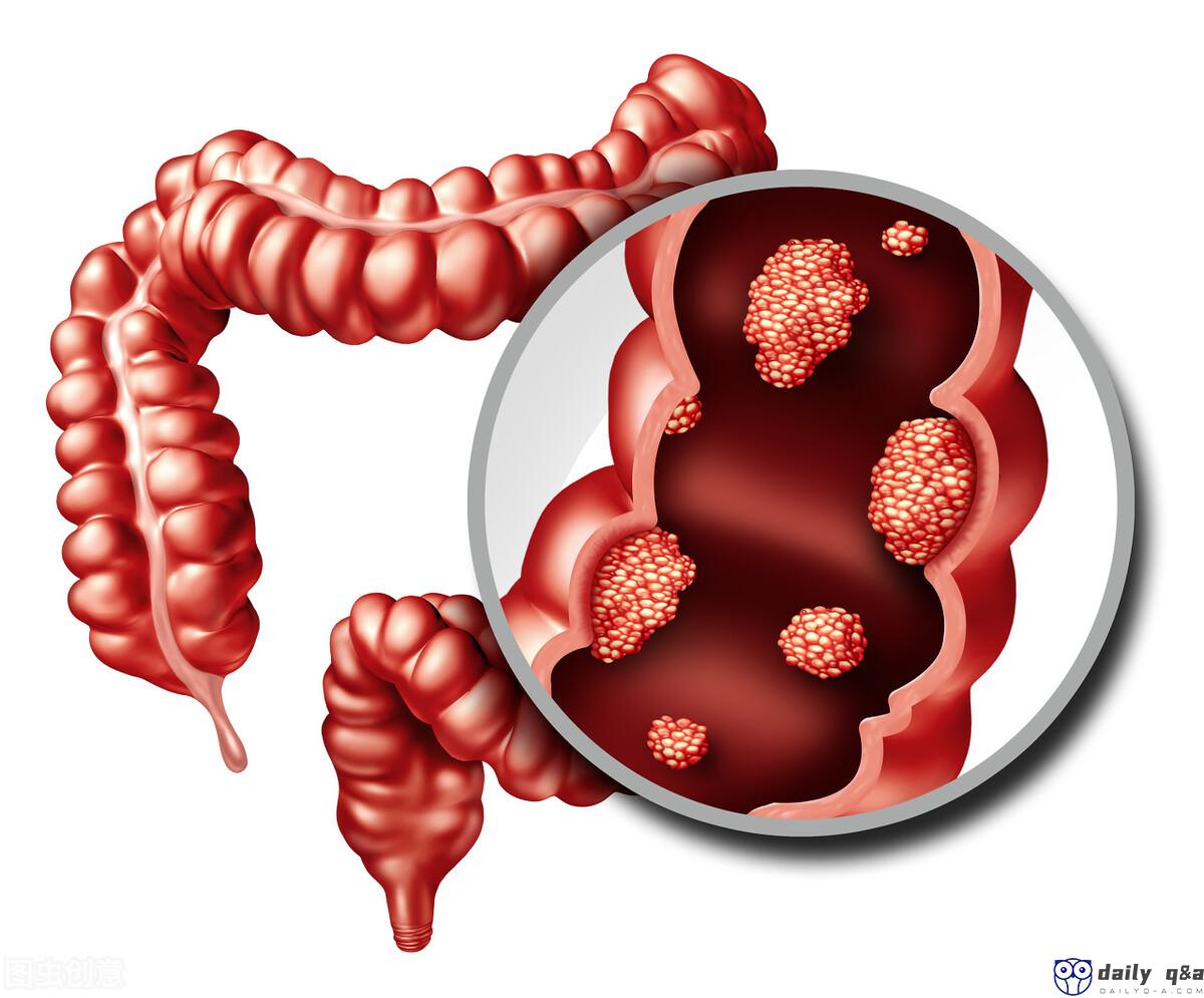 Beef is a Class 2A carcinogen. Will it cause cancer if eaten?  The doctor explained clearly in one article